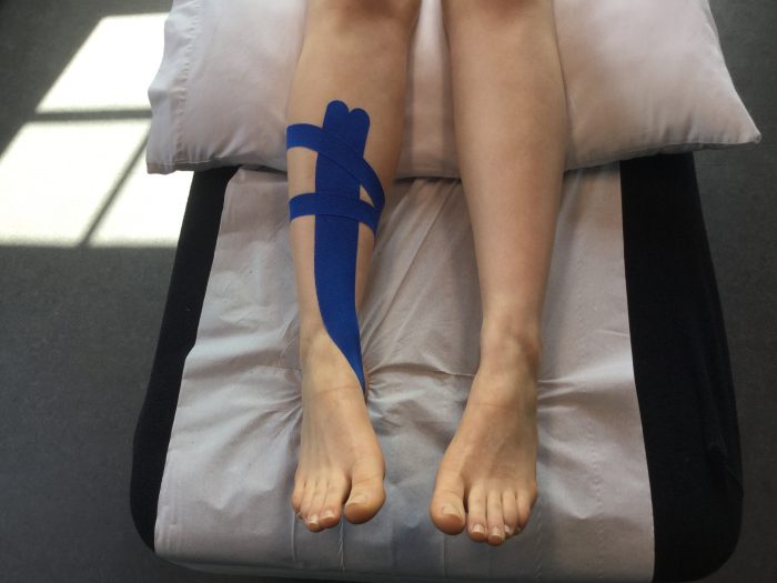 Shin splints treatment