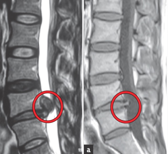 slipped disc