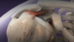 The sub-acromial area of the shoulder responsible for sub-acromial pain syndrome
