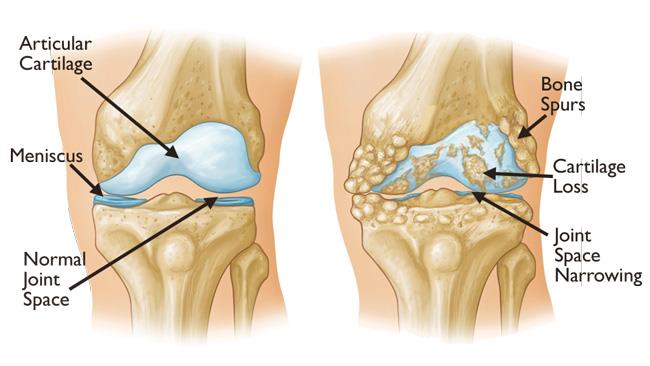 Knee osteoarthritis- What happens inside the joint