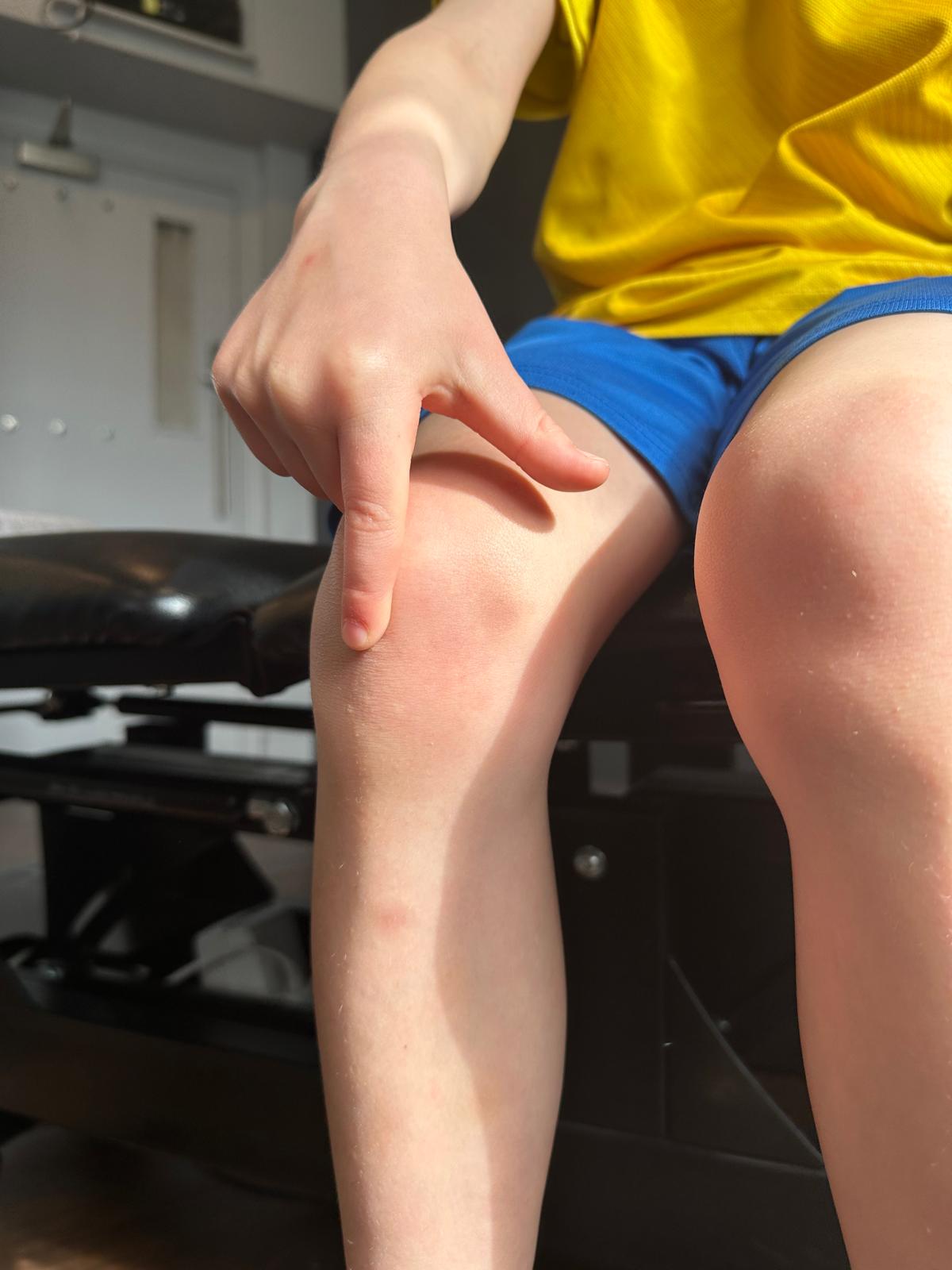 Patella apophysitis